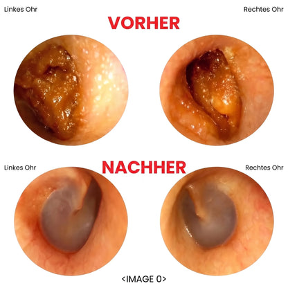 Intelligenter HD Ohrenreiniger OHMYSWISS