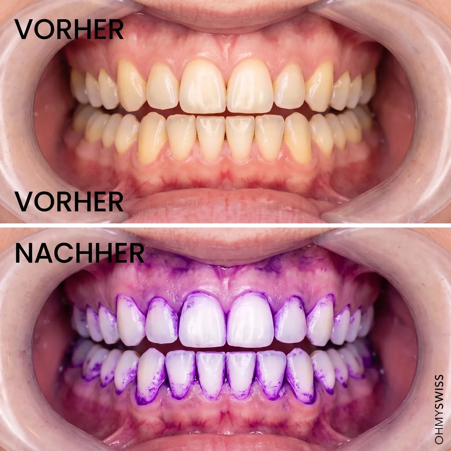 Strisce sbiancanti per i denti V34 OHMYSWISS