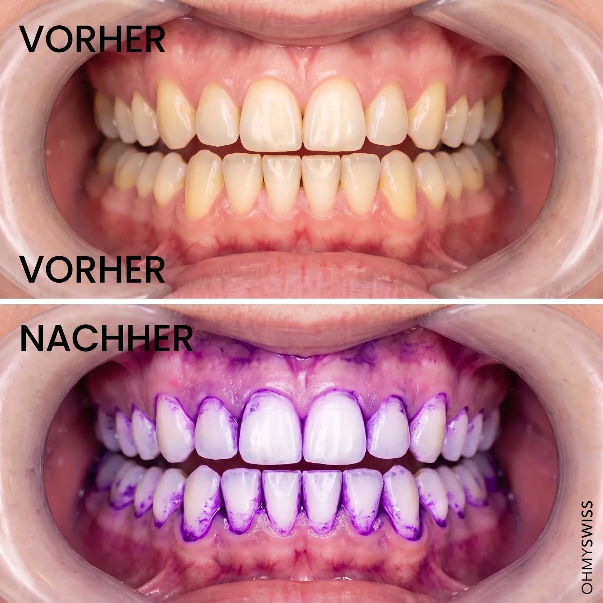 Strisce sbiancanti per i denti V34 OHMYSWISS